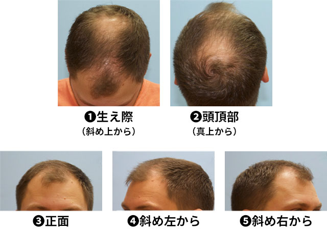 自毛植毛や薄毛治療、AGA治療に関する専門的な質問に対して内田先生が直接回答するサービスの案内。写真送付による相談も可能です。
